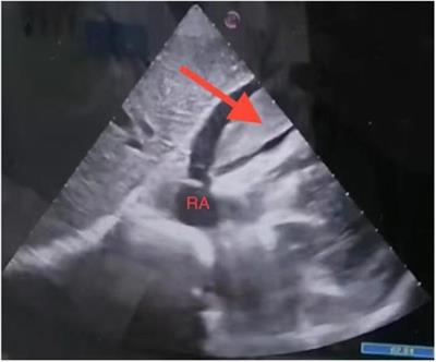 Case Report: Massive intrapericardial hematoma following acupuncture therapy